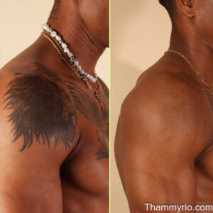 Laser tattoo removal before and after black skin on shoulder showing a lion tattoo being faded.