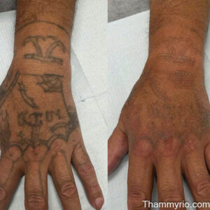 Laser tattoo removal before and after black skin on hand and wrist showing significant ink fading.