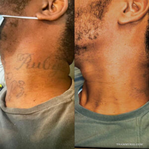 Before and after laser tattoo removal black skin on neck featuring name Ruby and letters P3.