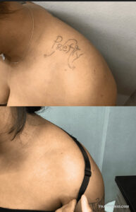 Before and after laser tattoo removal black skin on woman's shoulder showing faded script word "Pretty".