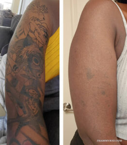 Before and after laser tattoo removal black skin of detailed full-arm sleeve.