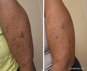 Detailed process of laser tattoo removal black skin on arm featuring anime cartoon characters.