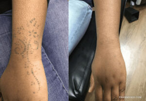 : Before and after laser tattoo removal black skin on wrist and hand showing faded floral patterns.