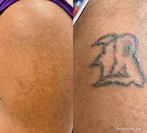 Before and after laser tattoo removal black skin showing total clearance of a stylized letter B tattoo.