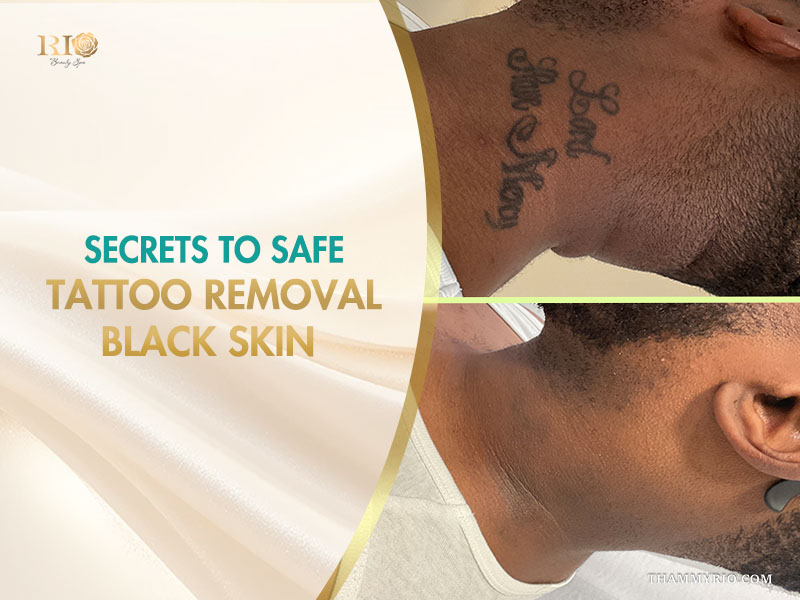 Safe and effective before and after laser tattoo removal black skin for a neck tattoo.