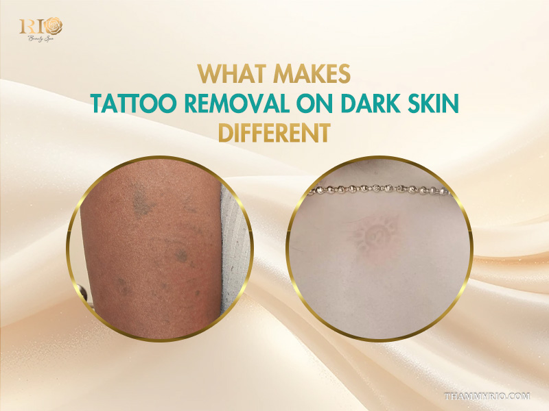 Professional laser tattoo removal black skin comparison showing fading process on arm and chest.
