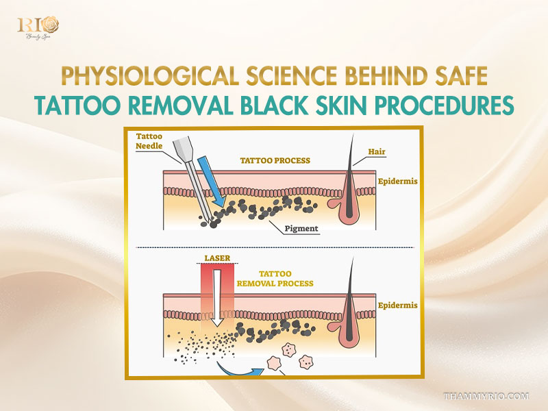 Diagram explaining physiological science of laser tattoo removal black skin showing epidermis and pigment breakdown.
