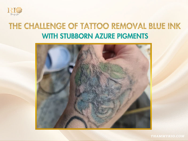 A close-up view of stubborn blue and green pigments on a hand tattoo at RIO Beauty Spa, highlighting tattoo removal challenges.