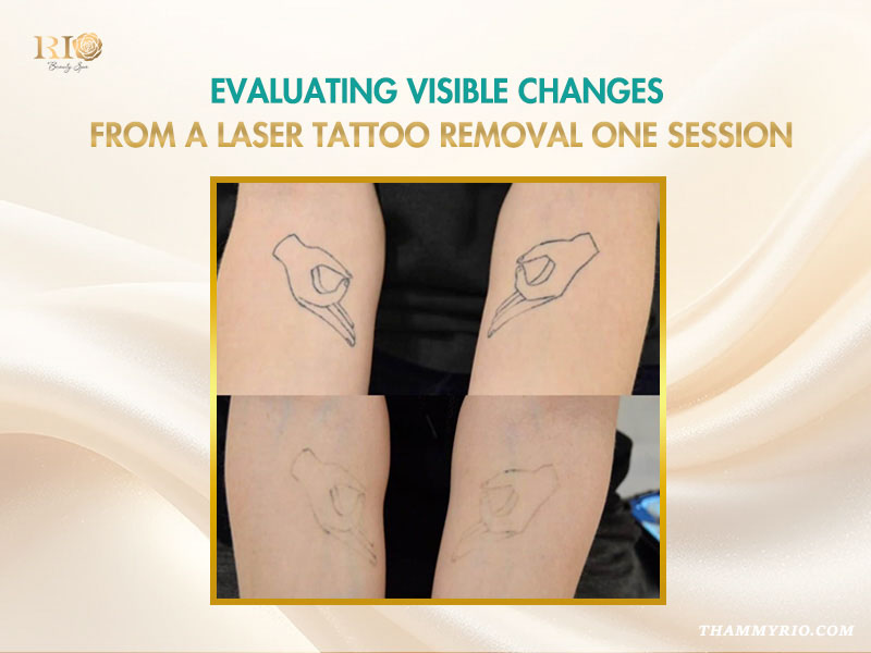 Before and after comparison showing visible ink fading of a hand gesture tattoo after a tattoo removal first session.