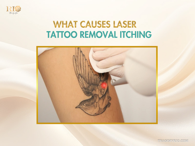 Laser tattoo removal on a bird tattoo.