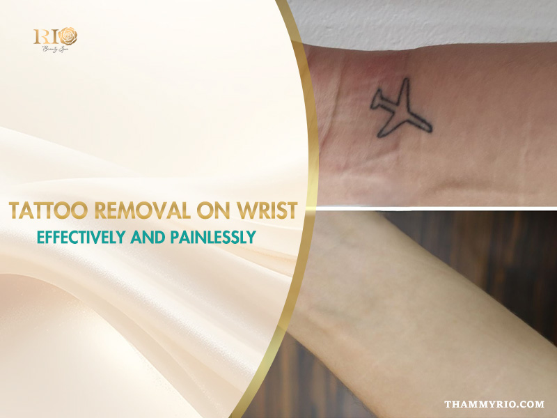 Before and after results of tattoo removal on wrist using laser technology at Rio Beauty Spa.