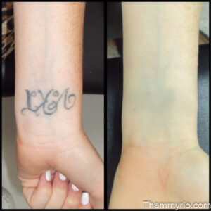Before and after comparison of a successful tattoo removal on wrist showing a faded black script tattoo.
