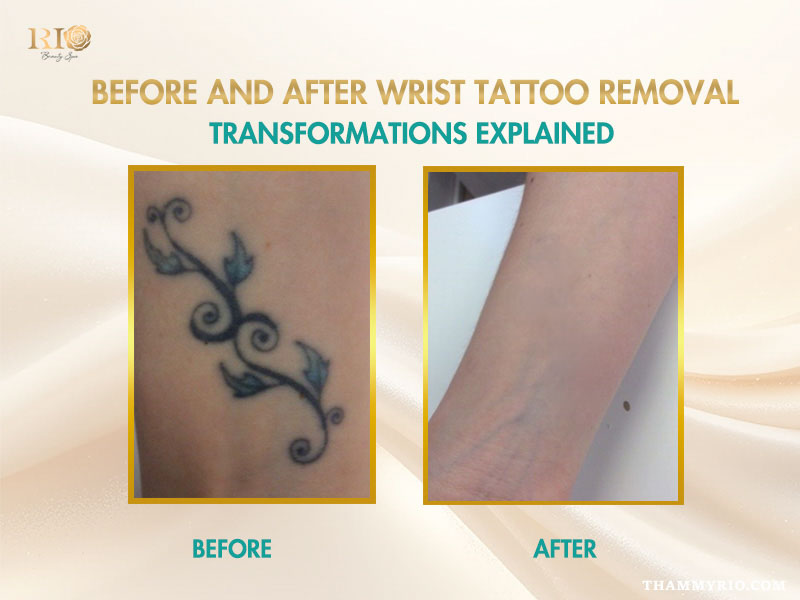 A detailed side-by-side before and after comparison of a vine-style tattoo removal on wrist.