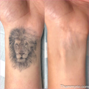 Tattoo removal on wrist effectively and painlessly in 2026 - Thẩm Mỹ Rio Beauty Clinic
