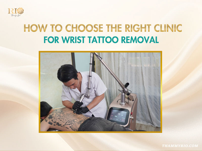 Professional laser tattoo removal on wrist and back at Rio Beauty Spa.