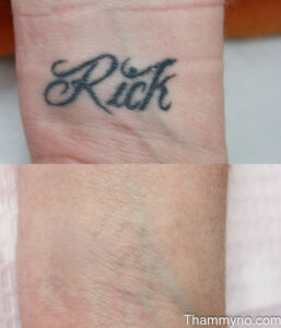 Before and after comparison of a professional tattoo removal on wrist for a black ink name tattoo.