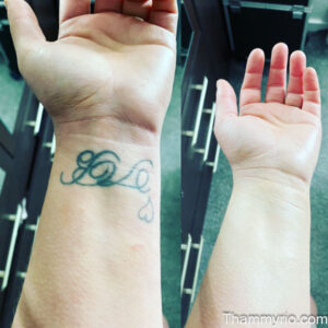 A side-by-side comparison of a wrist with a dark blue script tattoo and the final result of tattoo removal on wrist showing clear skin.