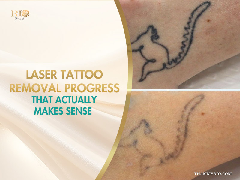 Laser tattoo removal progress results for a fine-line squirrel tattoo at Thẩm Mỹ Rio Beauty Clinic.
