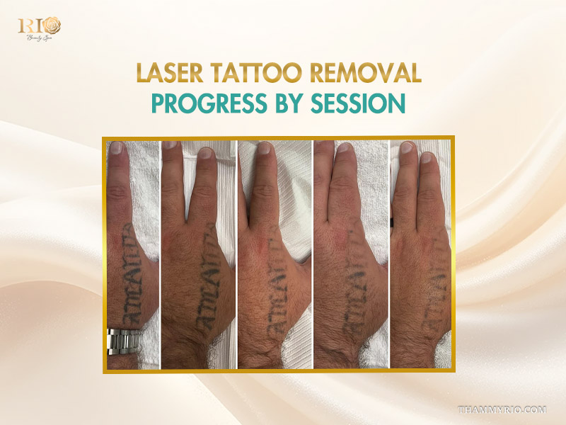Laser tattoo removal progress by session showing fading of a hand tattoo at Rio.