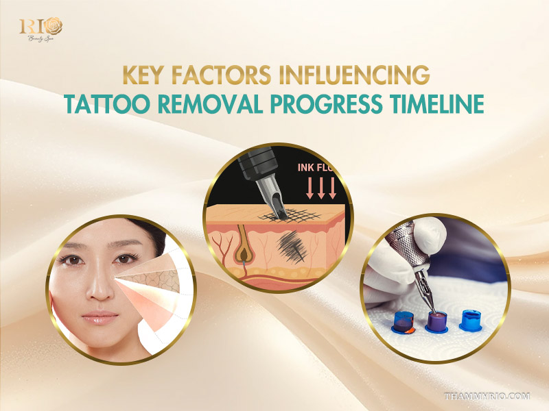 Illustration showing key factors affecting tattoo removal progress including skin type, ink depth, and pigment colors.