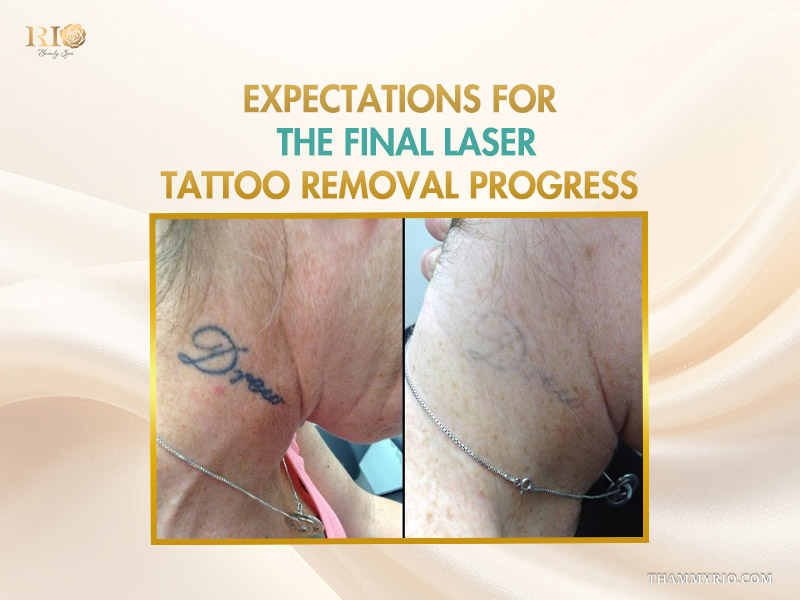 Before and after photo showing successful laser tattoo removal progress on the neck.