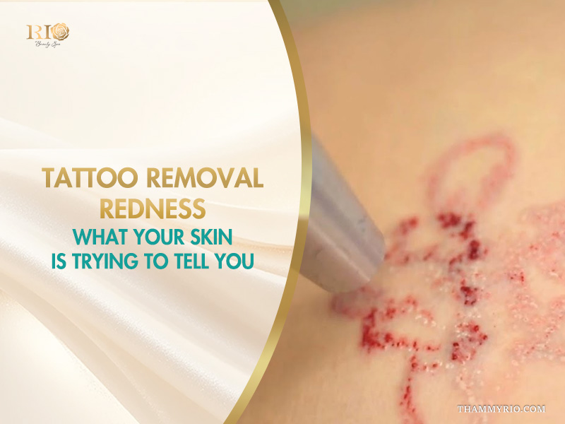 Close-up of tattoo removal redness and pinpoint bleeding during a laser treatment session.