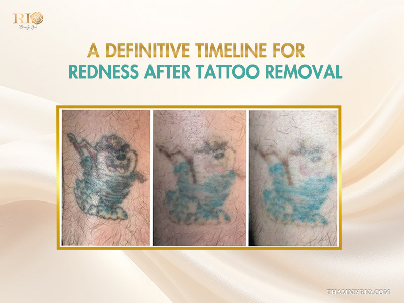 A definitive timeline showing the reduction of tattoo removal redness and ink fading over multiple sessions.