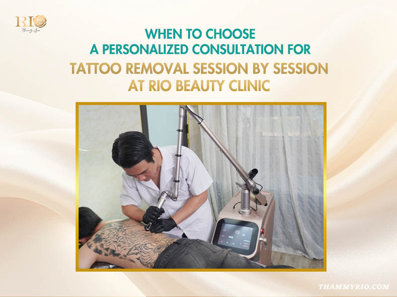 Professional tattoo removal session performed by a specialist on a large back tattoo at Rio Beauty Clinic.