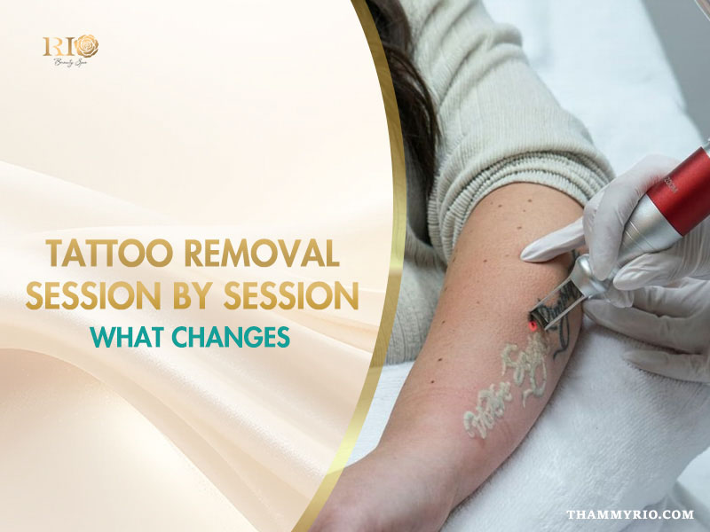 Professional laser tattoo removal session on an arm showing immediate frosting effect.