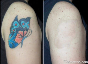 Before and after laser tattoo sleeve removal on shoulder featuring a butterfly design