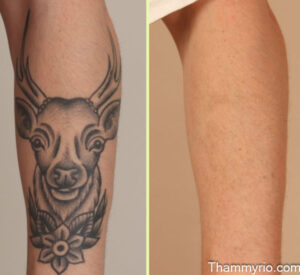 Before and after laser tattoo sleeve removal on lower leg