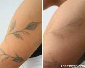 A split image showing the progress of laser tattoo sleeve removal on a forearm before and after several sessions.
