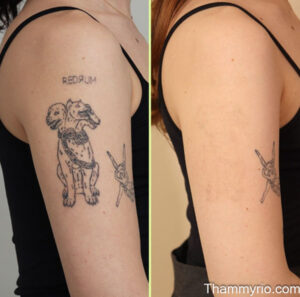 Tattoo sleeve removal before and after for arm tattoos with redrum and cerberus designs