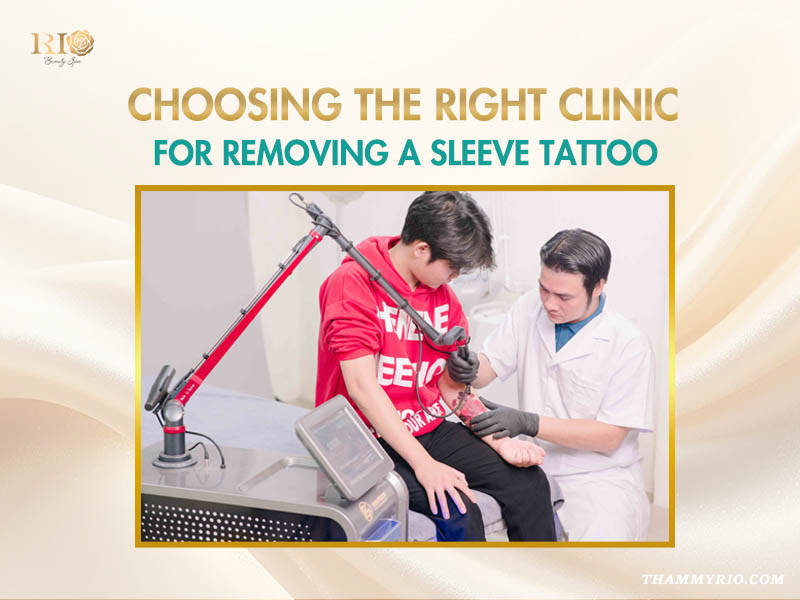 Professional laser tattoo sleeve removal procedure performed by a specialist at Rio Beauty Clinic.