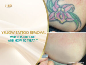 Before and after comparison of yellow tattoo removal on a floral design using advanced laser technology.