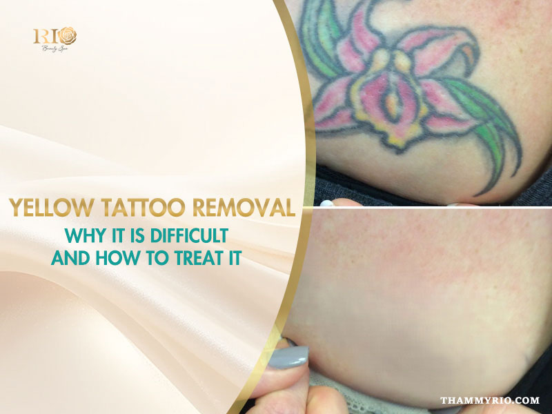 Before and after comparison of yellow tattoo removal on a floral design using advanced laser technology.
