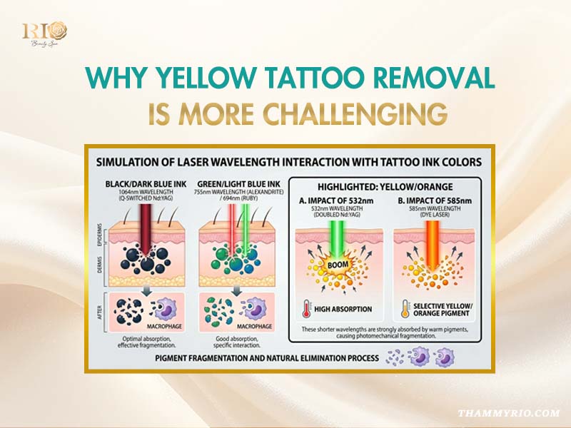 Illustration explaining why yellow tattoo removal is challenging using different laser wavelengths like 532nm and 585nm.