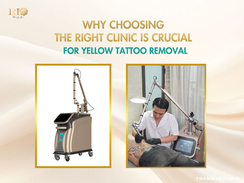 Professional laser machine and specialist performing yellow tattoo removal on a client's back.
