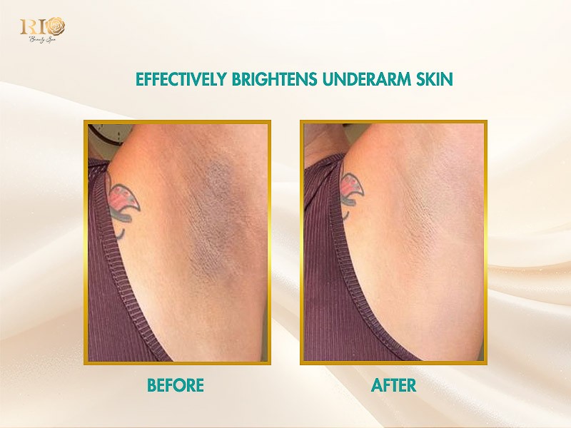 Before and after results: Safe and complete hair removal with Navy Ai Diode Laser.