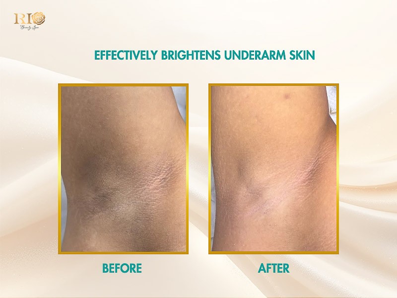 Before and after: Safe, long-lasting hair removal results using Navy Ai Diode Laser with AI technology.