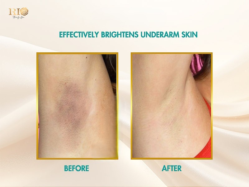 Navy AI Diode Laser Technology: The New Gold Standard for Fast and Painless Hair Reduction - Thẩm Mỹ Rio Beauty Clinic