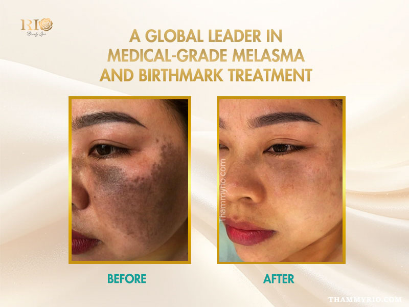 ND Yag Spectra laser system at Rio Beauty Clinic used for professional tattoo removal, melasma treatment, and freckle removal.
