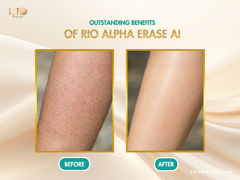 ALT Text: The ultimate trio of high-end hair removal machines featuring Rio Alpha Erase AI technology for superior results.