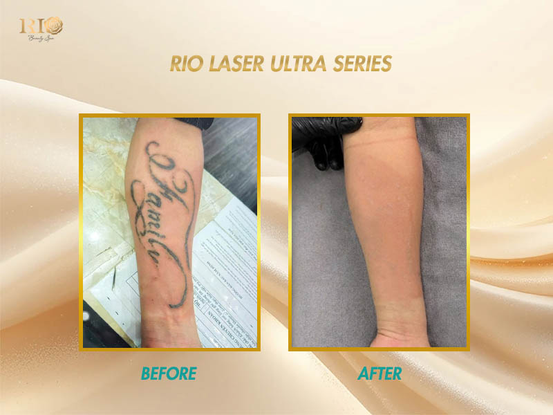 Expert combining Rio Laser Ultra Series with medical-grade skin-tone tattooing for rapid, high-coverage tattoo removal.