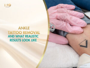 Professional ankle tattoo removal process on a small geometric triangle design at Rio Beauty Spa.