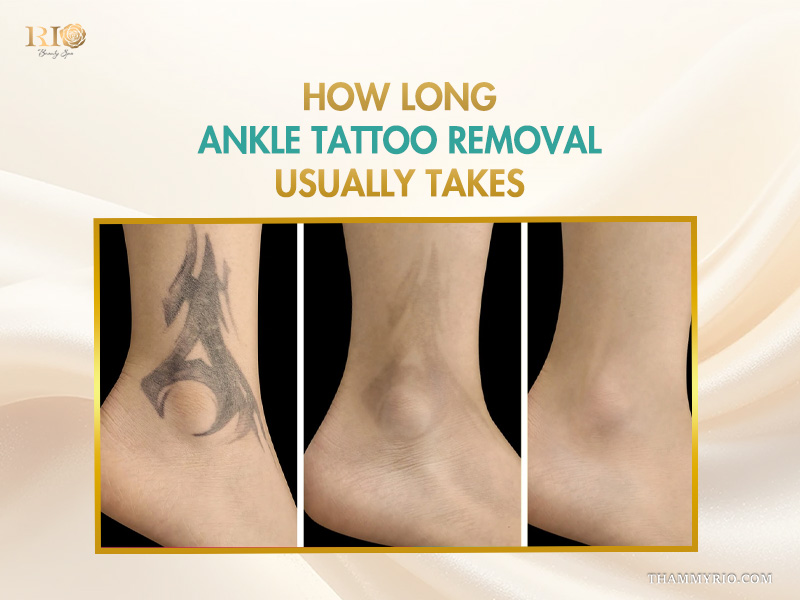 Before and after progression of ankle tattoo removal showing significant fading over multiple sessions.