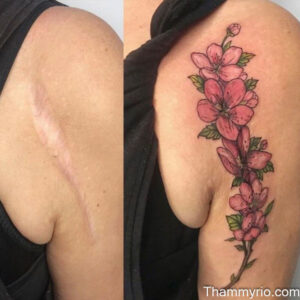 Before and after of an arm lift tattoo cover up using pink cherry blossom art on a surgical scar.