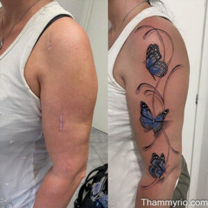 Before and after arm lift tattoo cover up showing a 3D blue butterfly design concealing surgical scars on the upper arm.