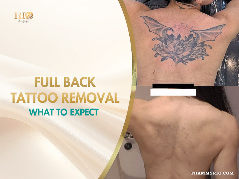 Before and after result of a professional back tattoo removal session at Rio Beauty Spa.
