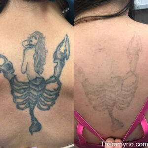 Comparison of a large woman-scorpion hybrid back tattoo removal before and after treatment.